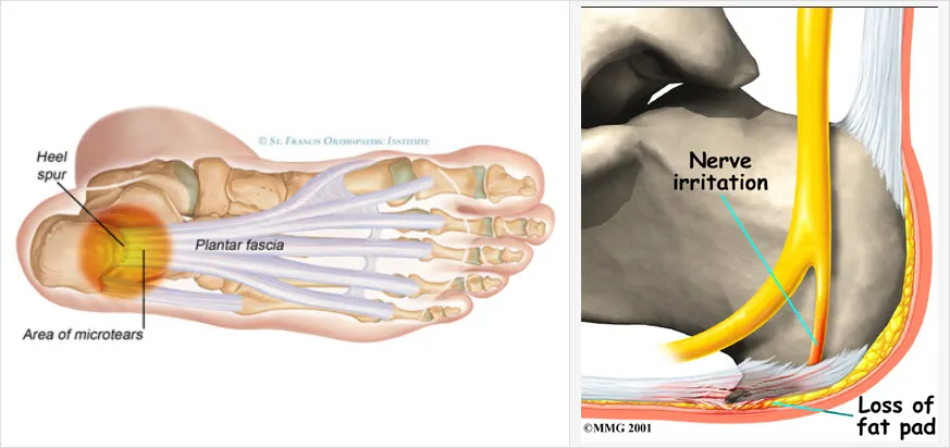 족저근막과 손상(염증)부위