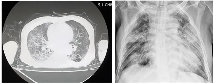 코로나19바이러스에 의해 발생한 폐손상 (국립중앙의료원)