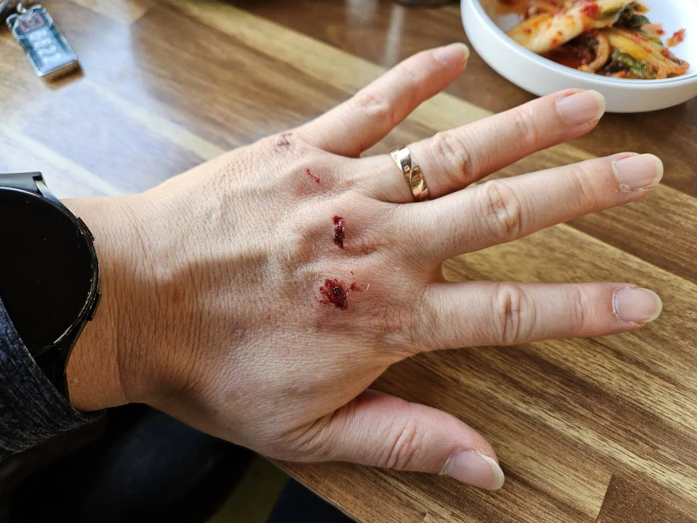 미끄러지며 다친 손등